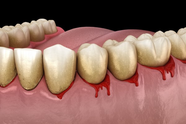 How Is Gum Disease Treated By A General Dentist?