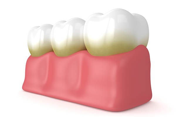 Preventative Dental Care Against Plaque and Tartar from Oro Valley Family Dentistry in Tucson, AZ