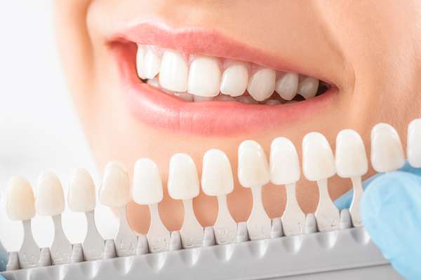 Caring for Veneers After a Cosmetic Dentist Treatment from Oro Valley Family Dentistry in Tucson, AZ