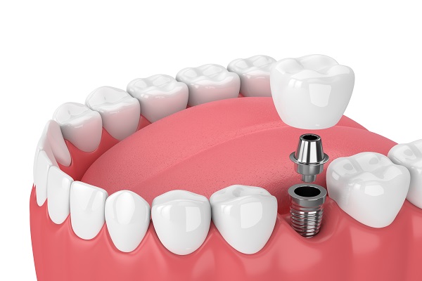Popular Cosmetic Dentistry Options For Teeth Discoloration