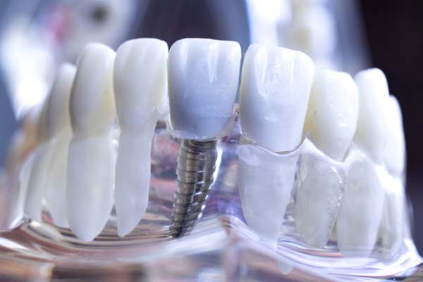 Dental Implants Tucson, AZ