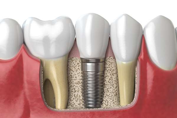 Dental Implants for Replacing Missing Teeth from Oro Valley Family Dentistry in Tucson, AZ