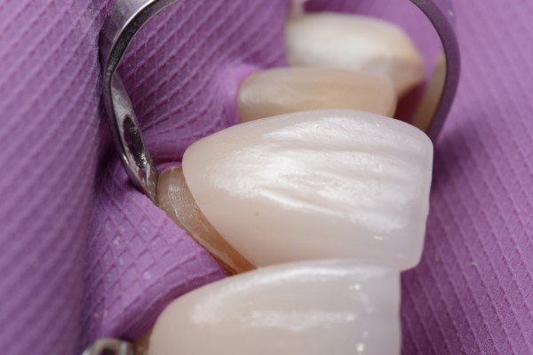 Can Dental Veneers Be Removed?