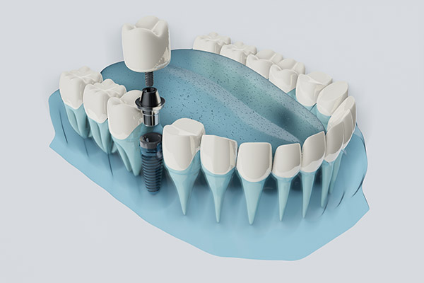 FAQs about Dental Implants from Oro Valley Family Dentistry in Tucson, AZ