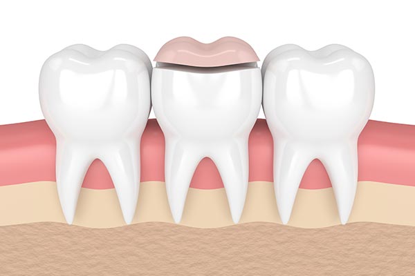 How a Cosmetic Dentist Can Place Inlays and Onlays from Tanque Verde Dental in Tucson, AZ