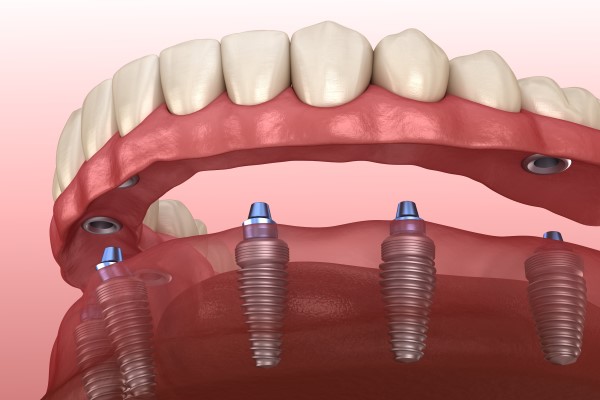 Improve Your Oral Health With Implant Supported Dentures